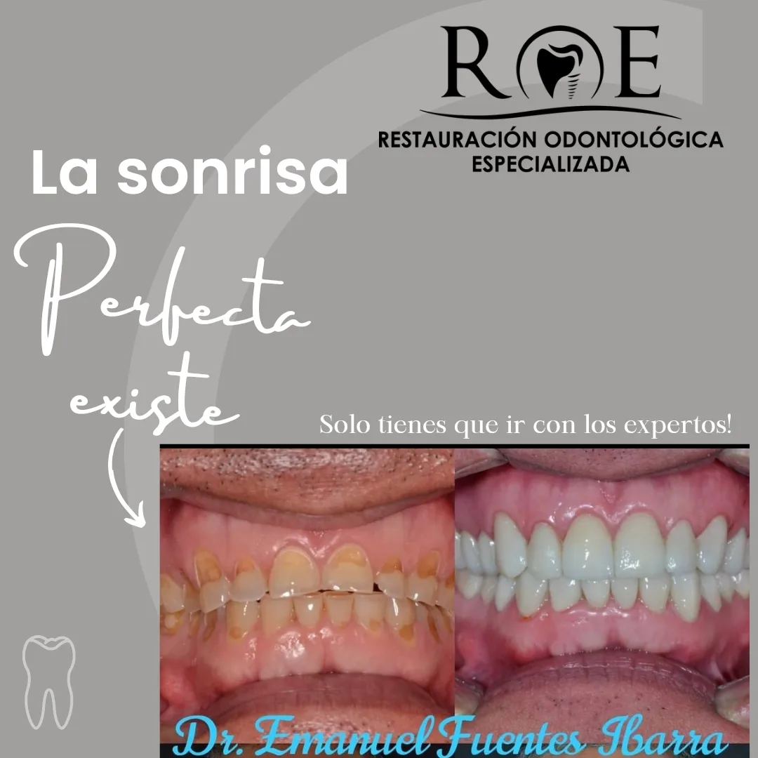 Caso clínico de restauración dental realizado en Clínica Dental ROE