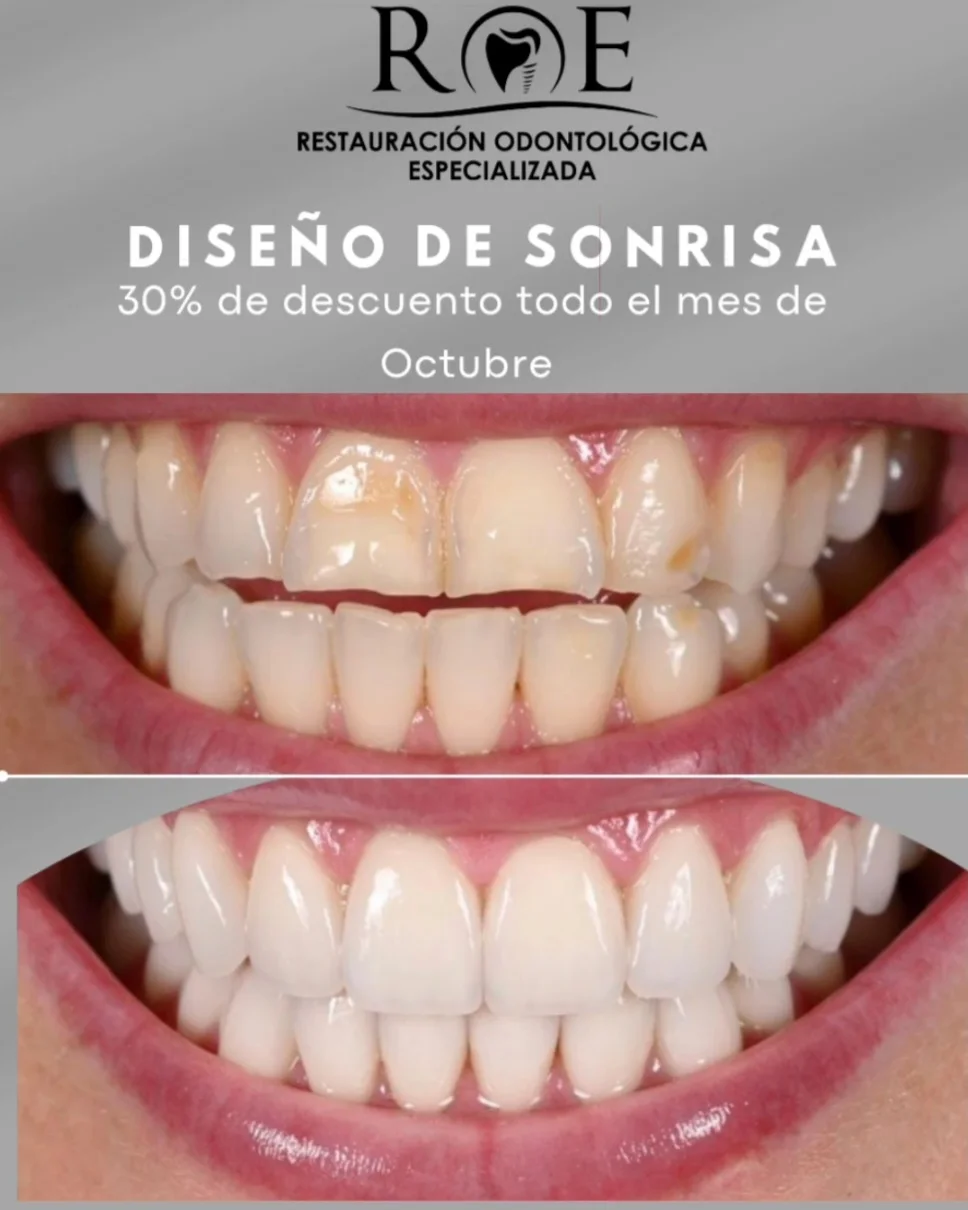 Resultado de rehabilitación dental en Clínica Dental ROE