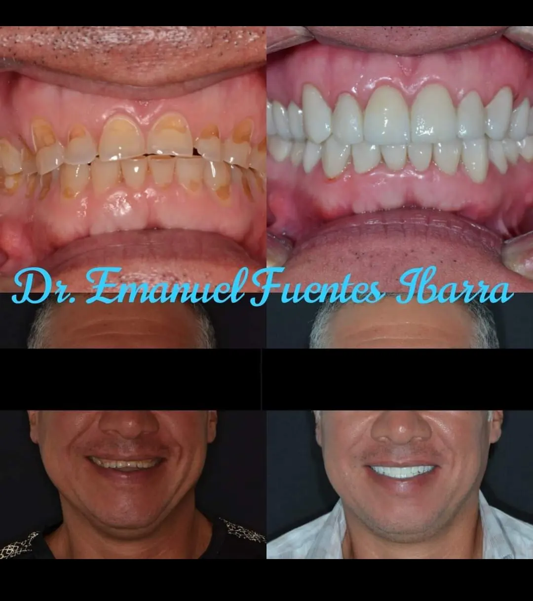 Caso clínico de estética dental en Clínica Dental ROE