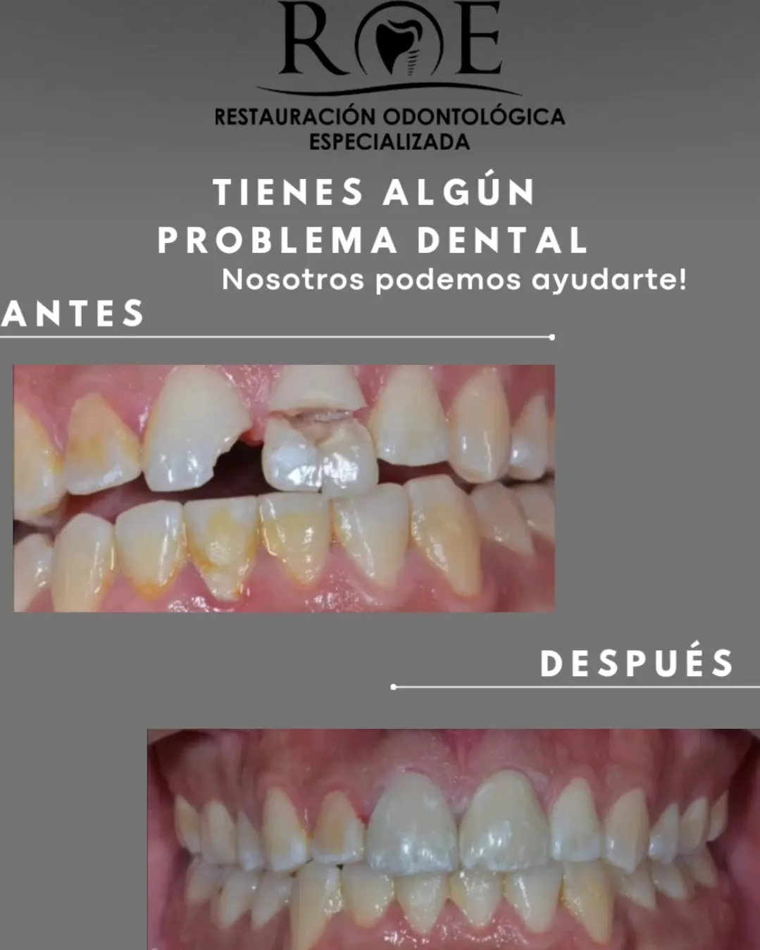 Caso clínico de implante dental en Clínica Dental ROE