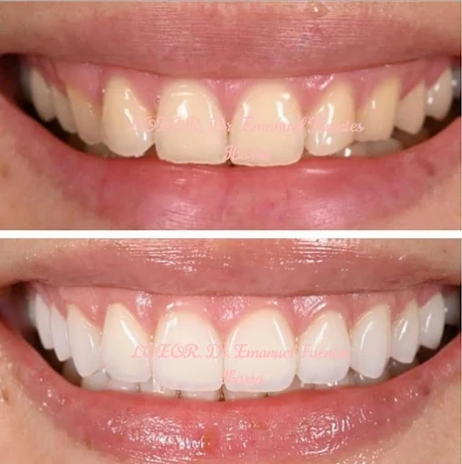 Tratamiento dental restaurador en Clínica Dental ROE